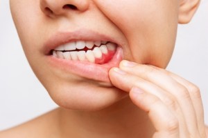 woman showing inflammed gums