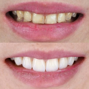 before and after teeth whitening